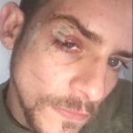 Imagen de las lesiones sufridas por Álex Casademunt