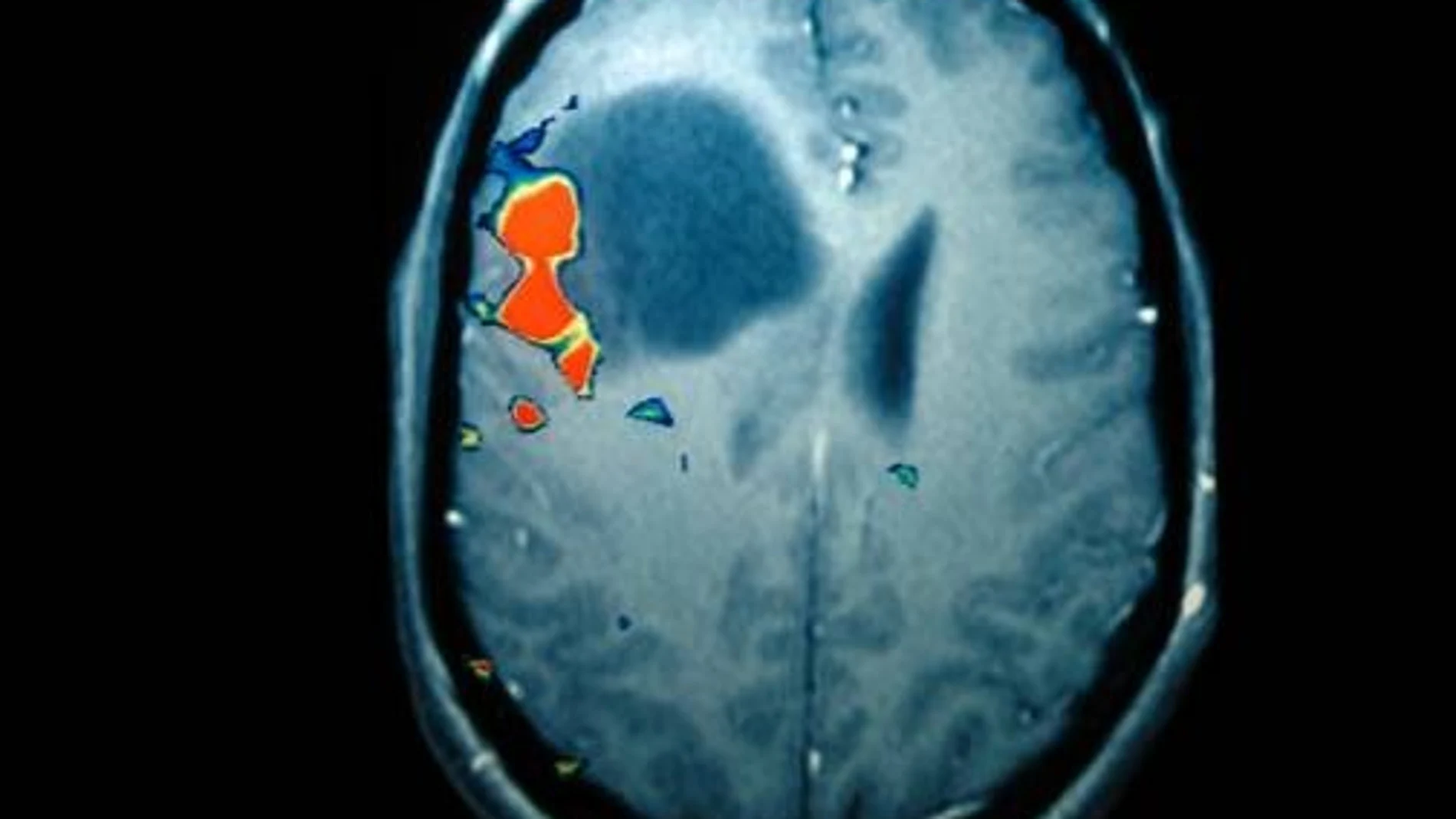 Escáner de un tumor cerebral