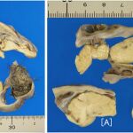 Un tumor en el ovario de una joven escondía en su interior un cerebro y hueso craneal