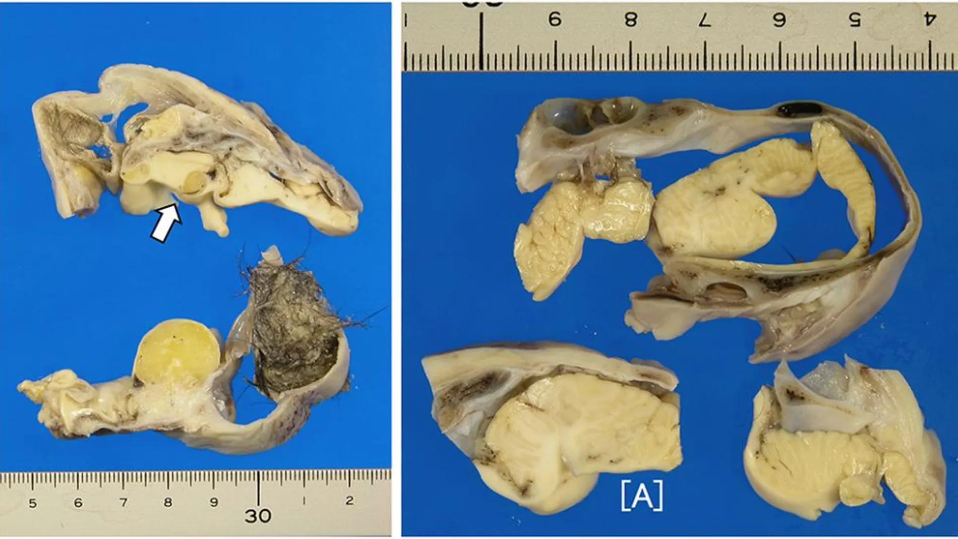 Un tumor en el ovario de una joven escondía en su interior un cerebro y hueso craneal