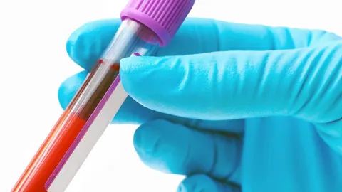 Los investigadores han desarrollado un innovador análisis de sangre que predice el riesgo de la esquizofrenia