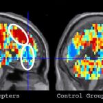 Zonas del cerebro activadas ante la palabra «muerte», en pacientes (izda.) y en el grupo de control (dcha.)