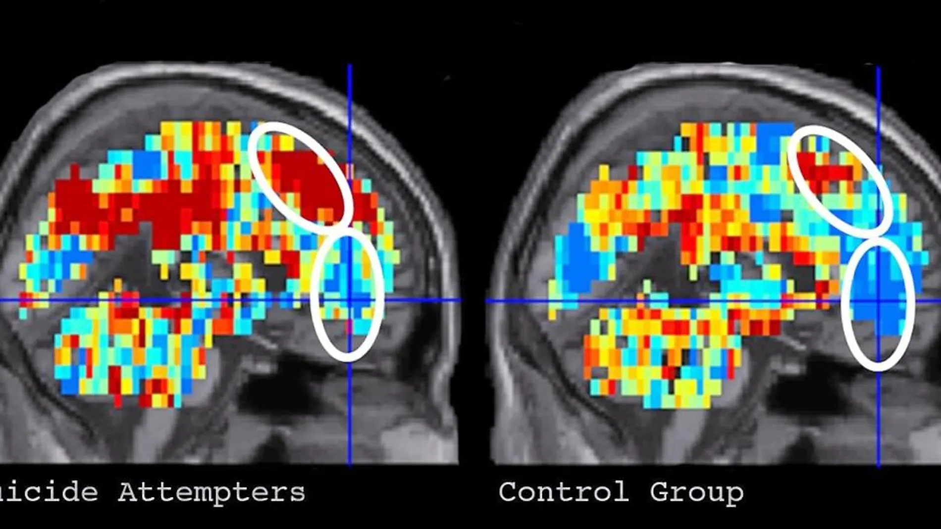 Zonas del cerebro activadas ante la palabra «muerte», en pacientes (izda.) y en el grupo de control (dcha.)