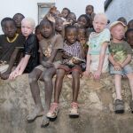 El macabro mercado de huesos humanos de albinos en Malaui