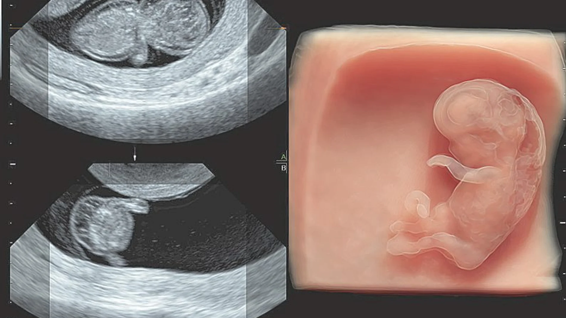 Un ecógrafo detecta el 90% de las malformaciones en el feto