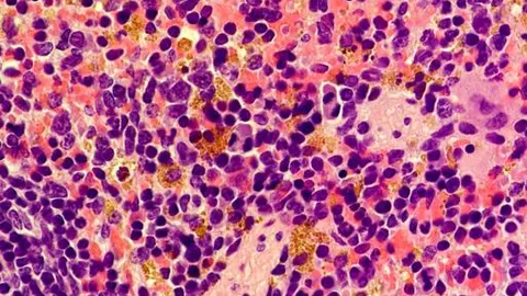 Imagen histológica del hígado de ratones deficientes en RPL11. Los acúmulos de color dorado corresponden a hemosiderina, que a su vez es manifestación de la anemia que sufren estos ratones