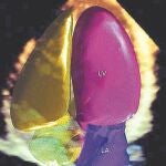 La tecnología reciente de imágenes 3D automatizadas, con cuantificación avanzada para imágenes de ultrasonido cardiaco, ayuda a hacer frente a algunas cuestiones críticas en los hospitales