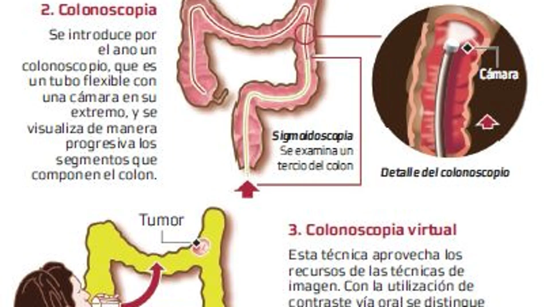 Una muestra de sangre para detectar el cáncer colorrectal