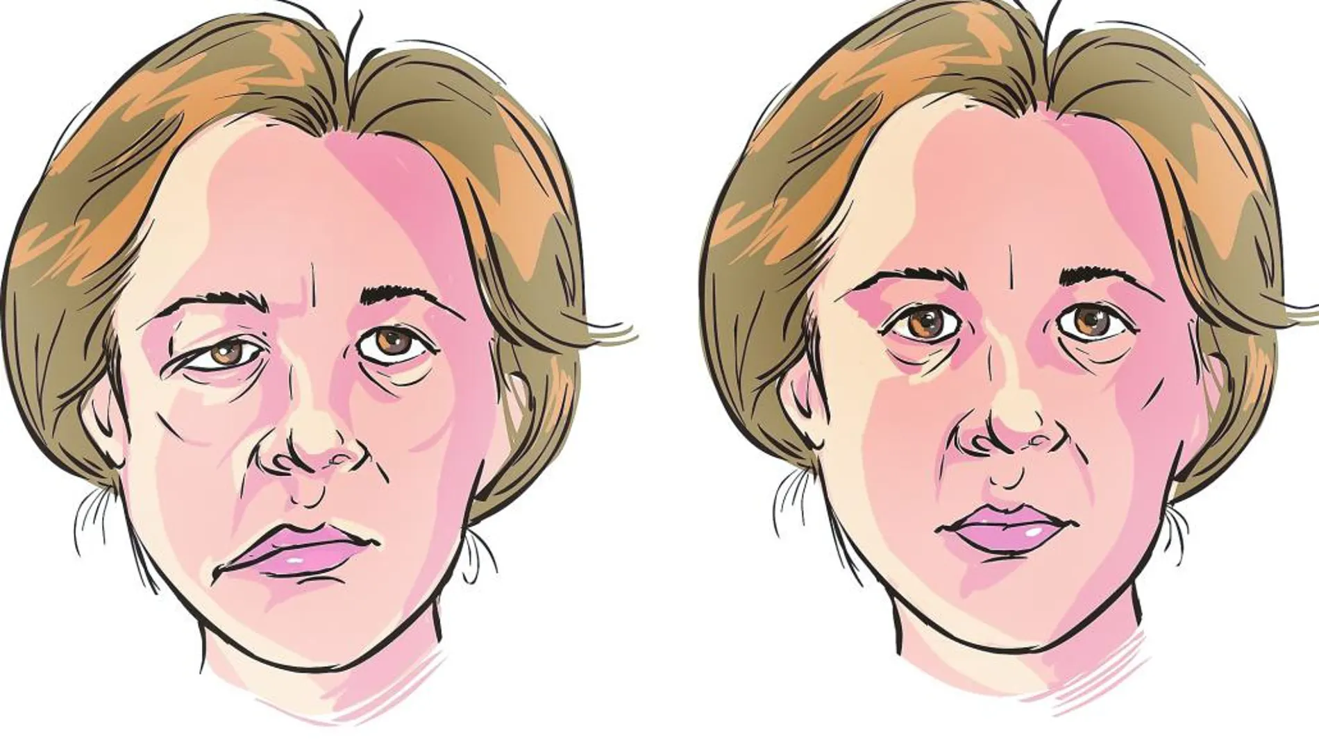 La parálisis facial que hay detrás de la varicela