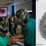 Trasplante de células alveolares tipo II a un paciente con fibrosis pulmonar idiopática (izquierda) y célula alveolar (derecha)