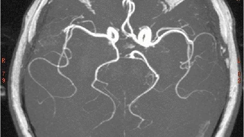 Una resonancia en el cerebro