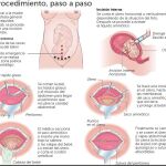 Cesáreas humanizadas que buscan el bienestar de la madre y el bebé