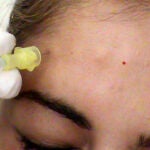 Los pacientes con parálisis facial recuperan la sonrisa
