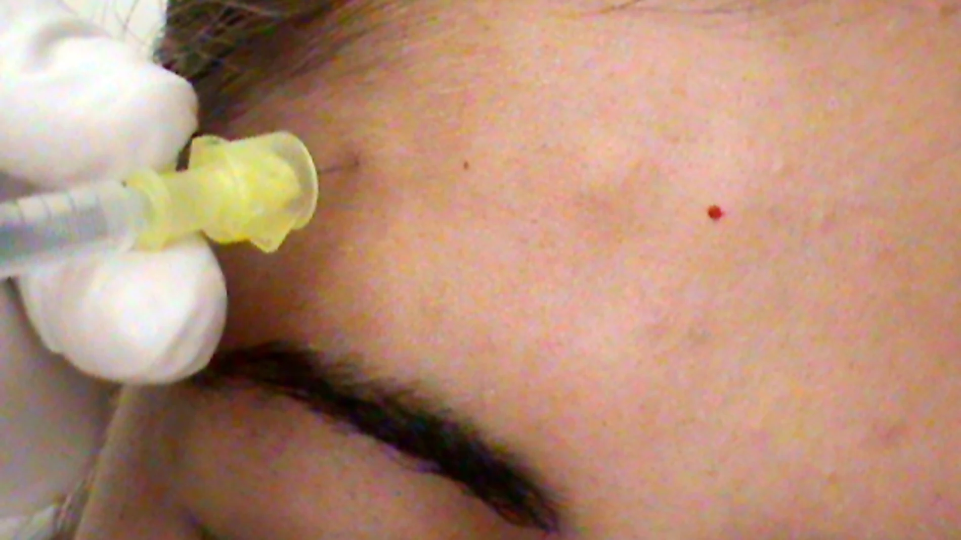 Los pacientes con parálisis facial recuperan la sonrisa