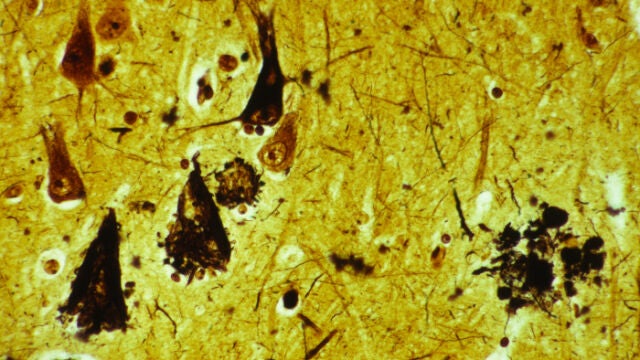 Imagen del cortex cerebral de un paciente con Alzheimer.