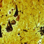 Imagen del cortex cerebral de un paciente con Alzheimer.