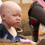 Imagen de un niño albino de Burundi