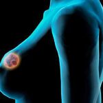 La supervivencia en los casos de cáncer de mama ha mejorado