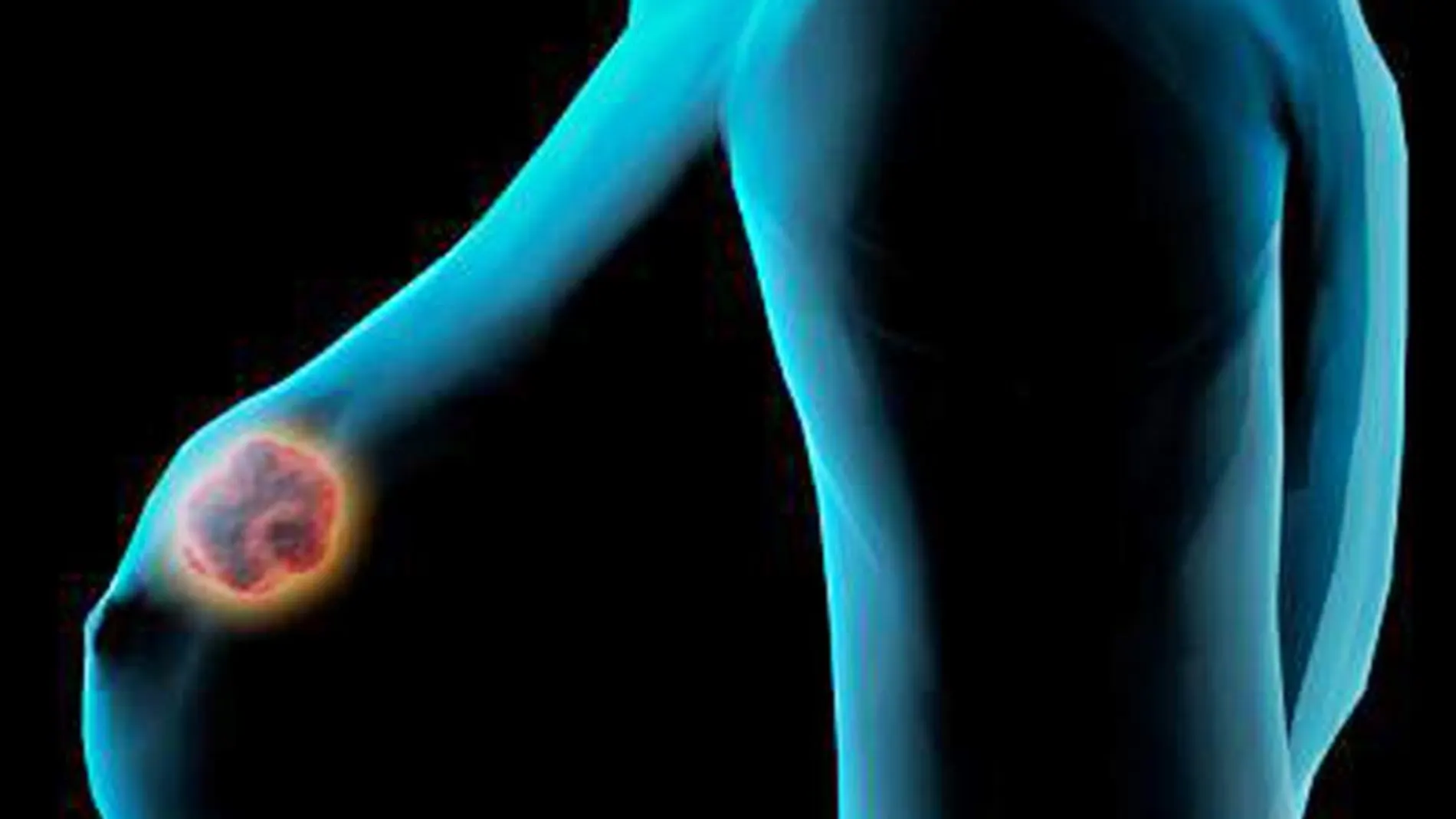La supervivencia en los casos de cáncer de mama ha mejorado