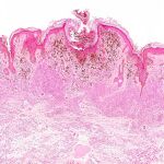 El melanoma es el tipo de cáncer de piel más grave