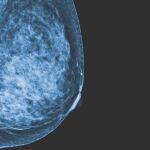 Un grupo de pacientes con cáncer de mama se ahorrará la quimio