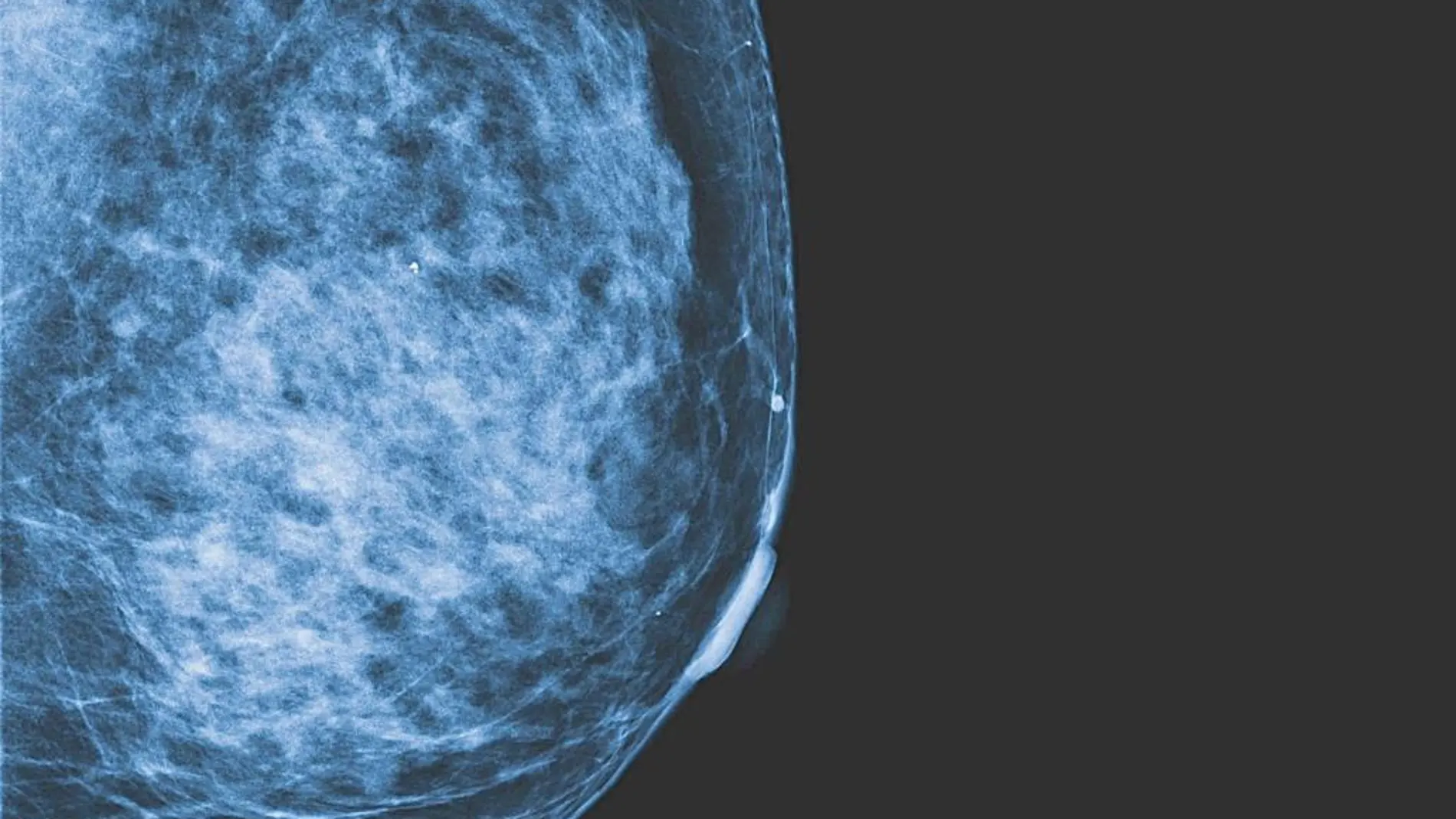 Un grupo de pacientes con cáncer de mama se ahorrará la quimio