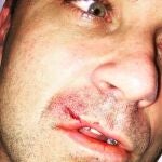 Imagen de Robbie Williams tras sufrir un corte en su labio superior