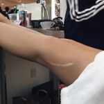 Kilye Jenner presume de cicatriz