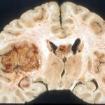 Una alteración bioquímica explica la resistencia de tumores cerebrales agresivos