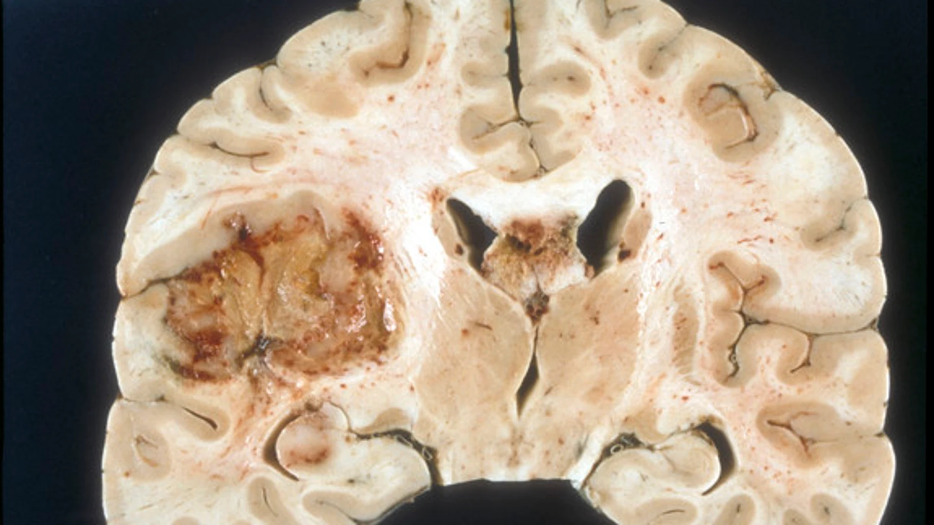 Una alteración bioquímica explica la resistencia de tumores cerebrales agresivos