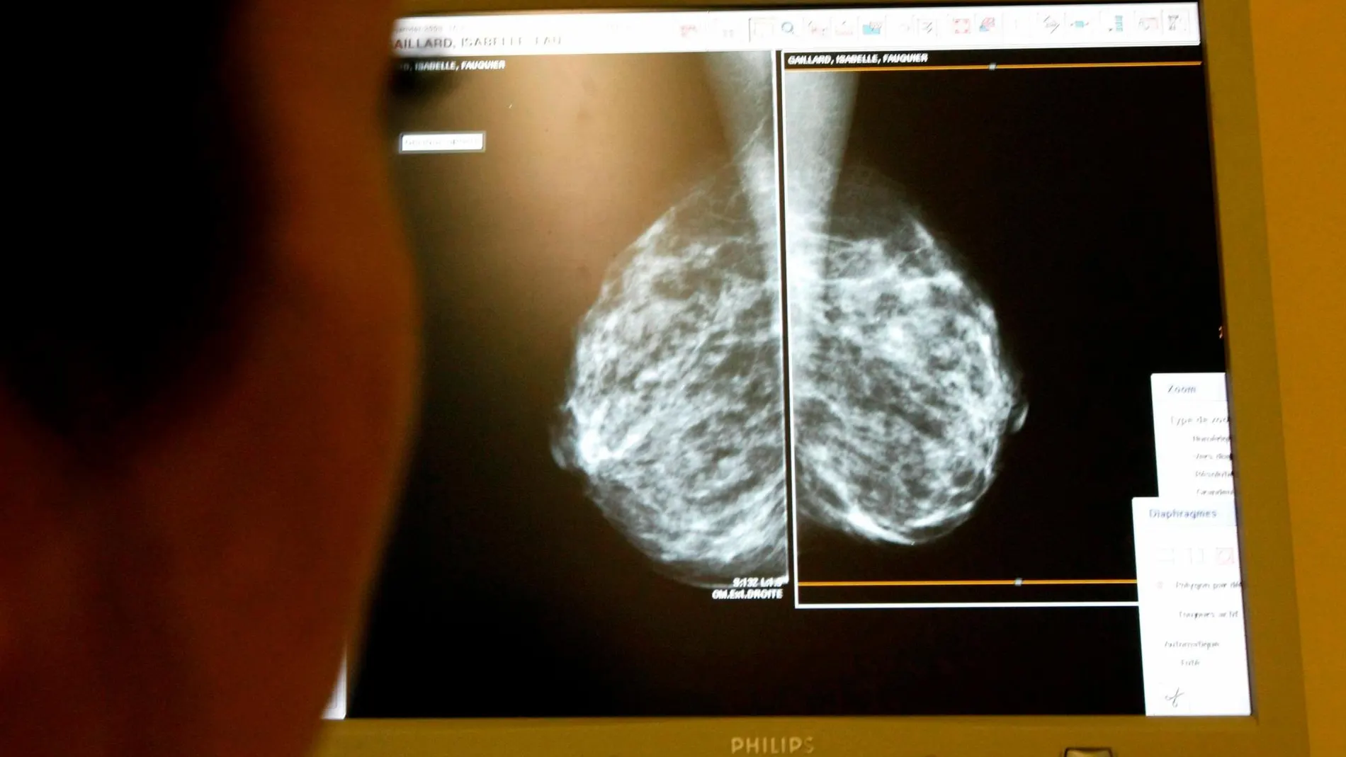 Radiografía de cáncer de mama / Foto: Reuters