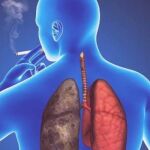 Por primera vez, el cáncer de pulmón se convierte en el tercero con mayor incidencia en el sexo femenino, después del de mama y el colorrectal.