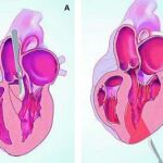 A. Cuando la alteración se halla en la pared ventricular, acceden a la misma a través de la aorta y realizan una incisión para facilitar la salida de sangre del órgano.