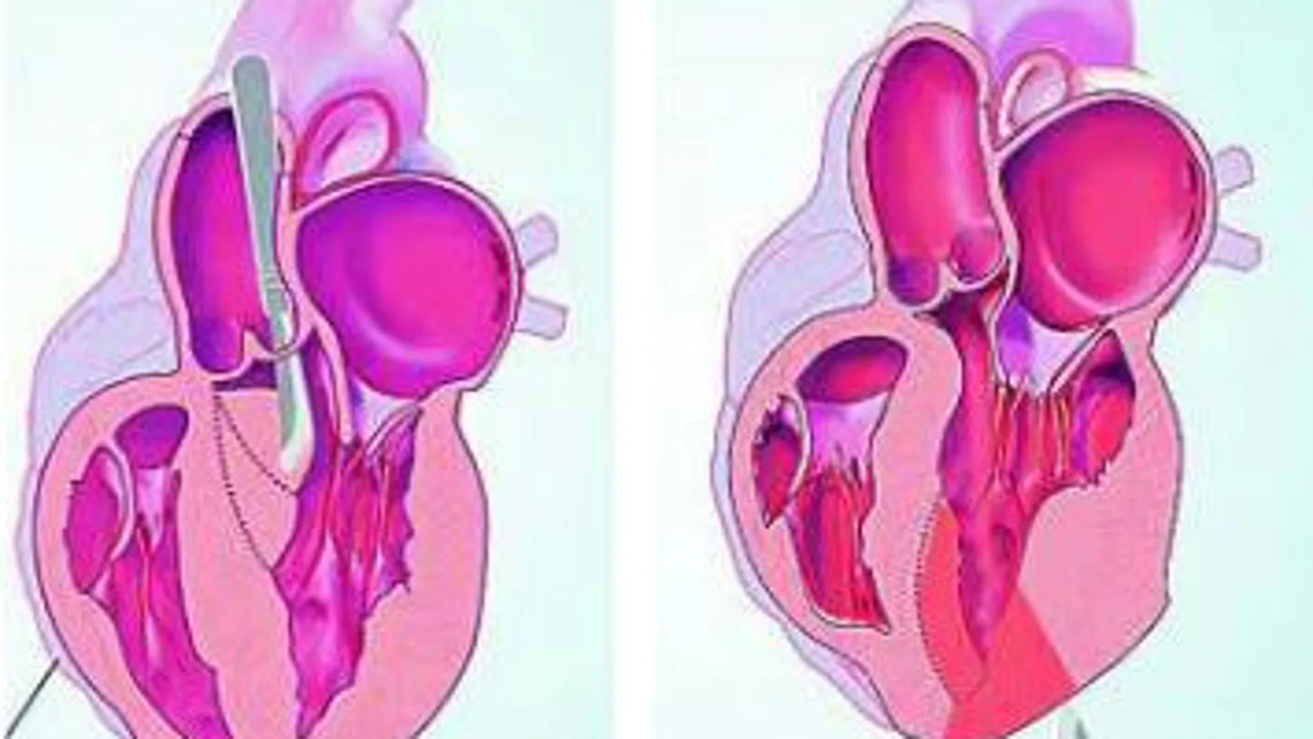A. Cuando la alteración se halla en la pared ventricular, acceden a la misma a través de la aorta y realizan una incisión para facilitar la salida de sangre del órgano.