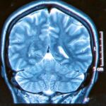 El gen culpable de que el cerebro se haga viejo