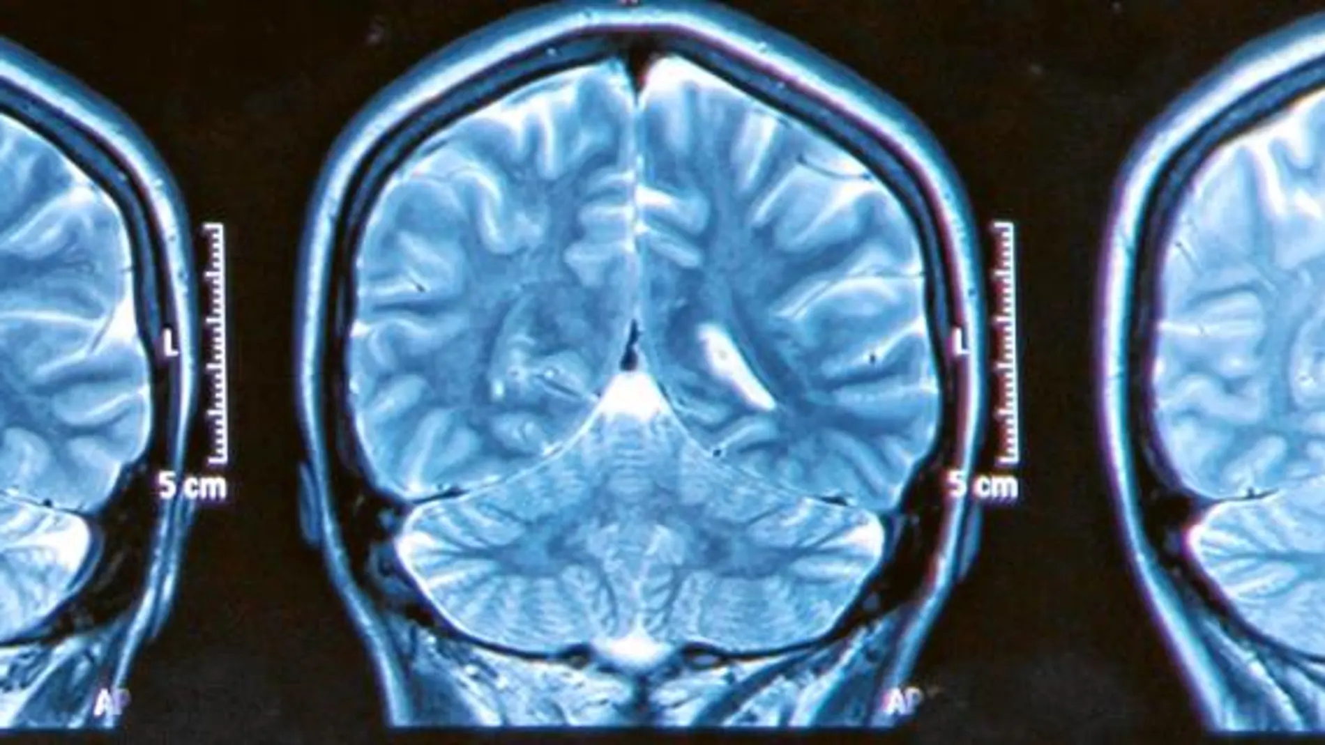 El gen culpable de que el cerebro se haga viejo