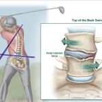 Efectos de este golpe en la lumbares / Journal of Neurosurgery: Spine