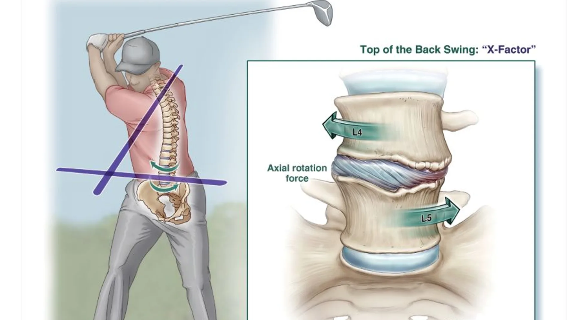 Efectos de este golpe en la lumbares / Journal of Neurosurgery: Spine