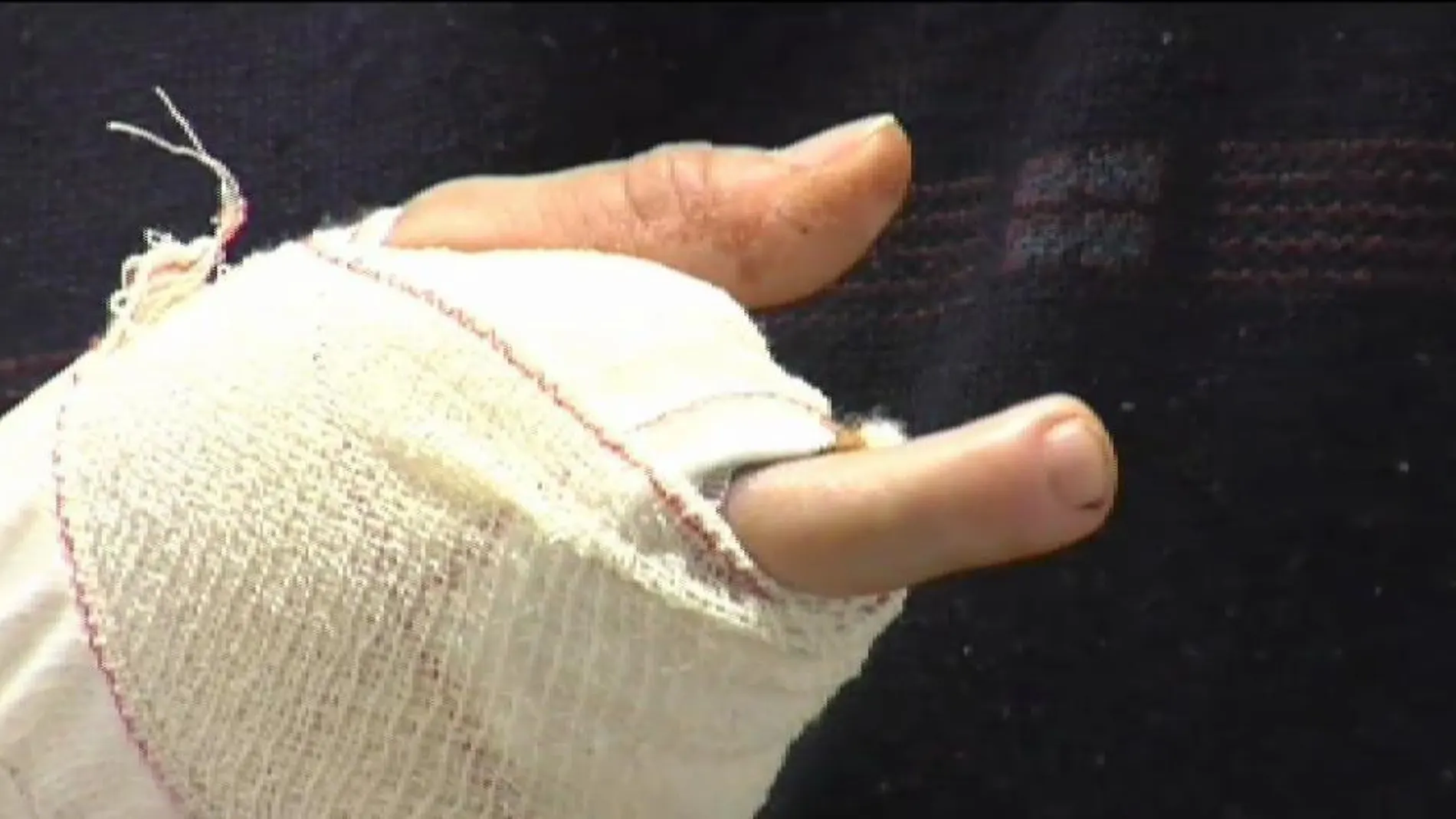 Le trasplantan un dedo del pie en la mano