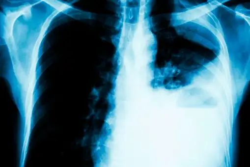 Un cribado de cáncer de pulmón, el más letal, lograría reducir la mortalidad en un 20-40% 
