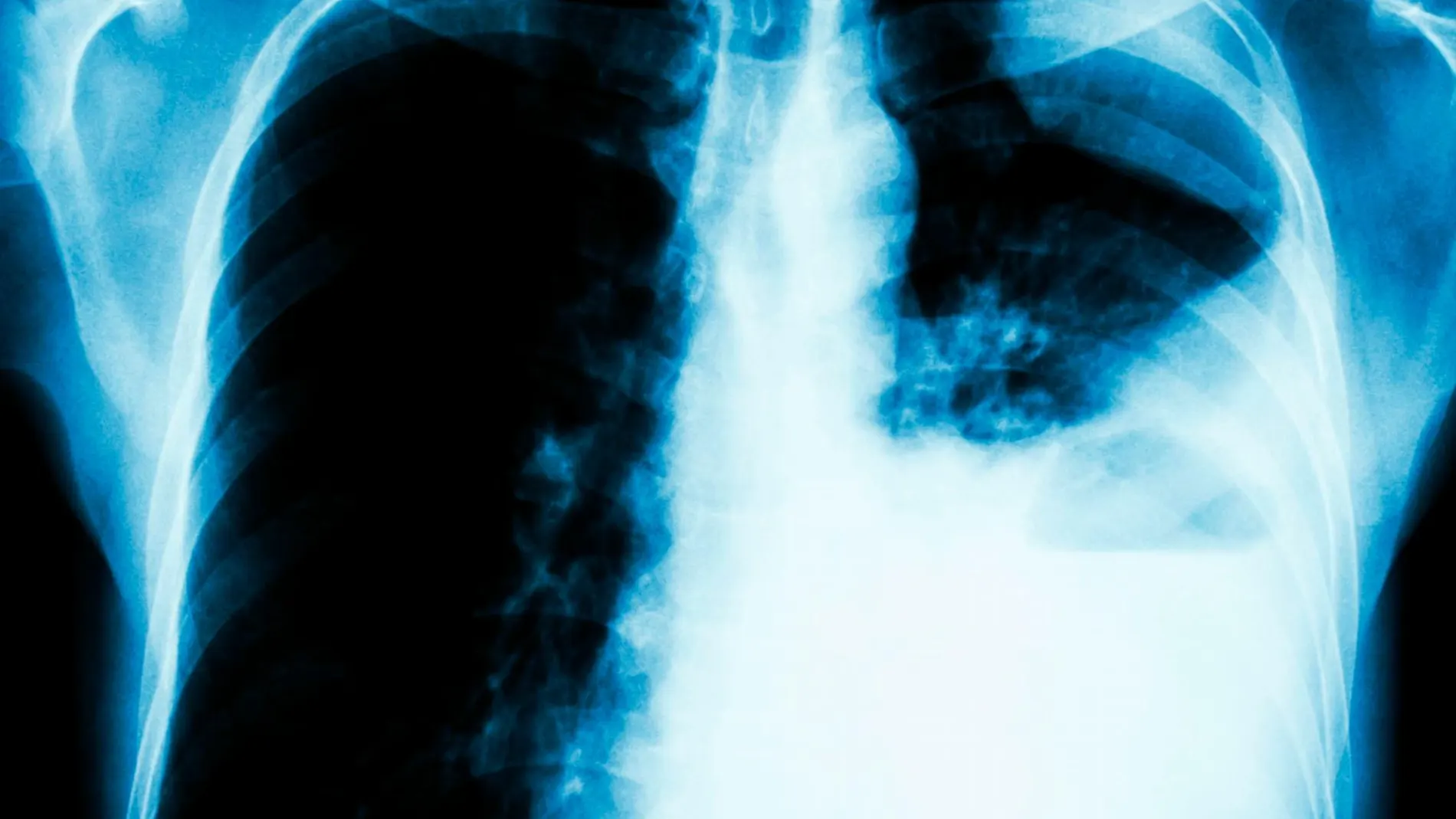 El cáncer de pulmón es el tercero más frecuente y principal causa de muerte por cáncer, tanto en hombres como en mujeres