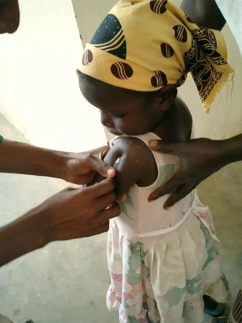 Una niña vacunada contra la malaria