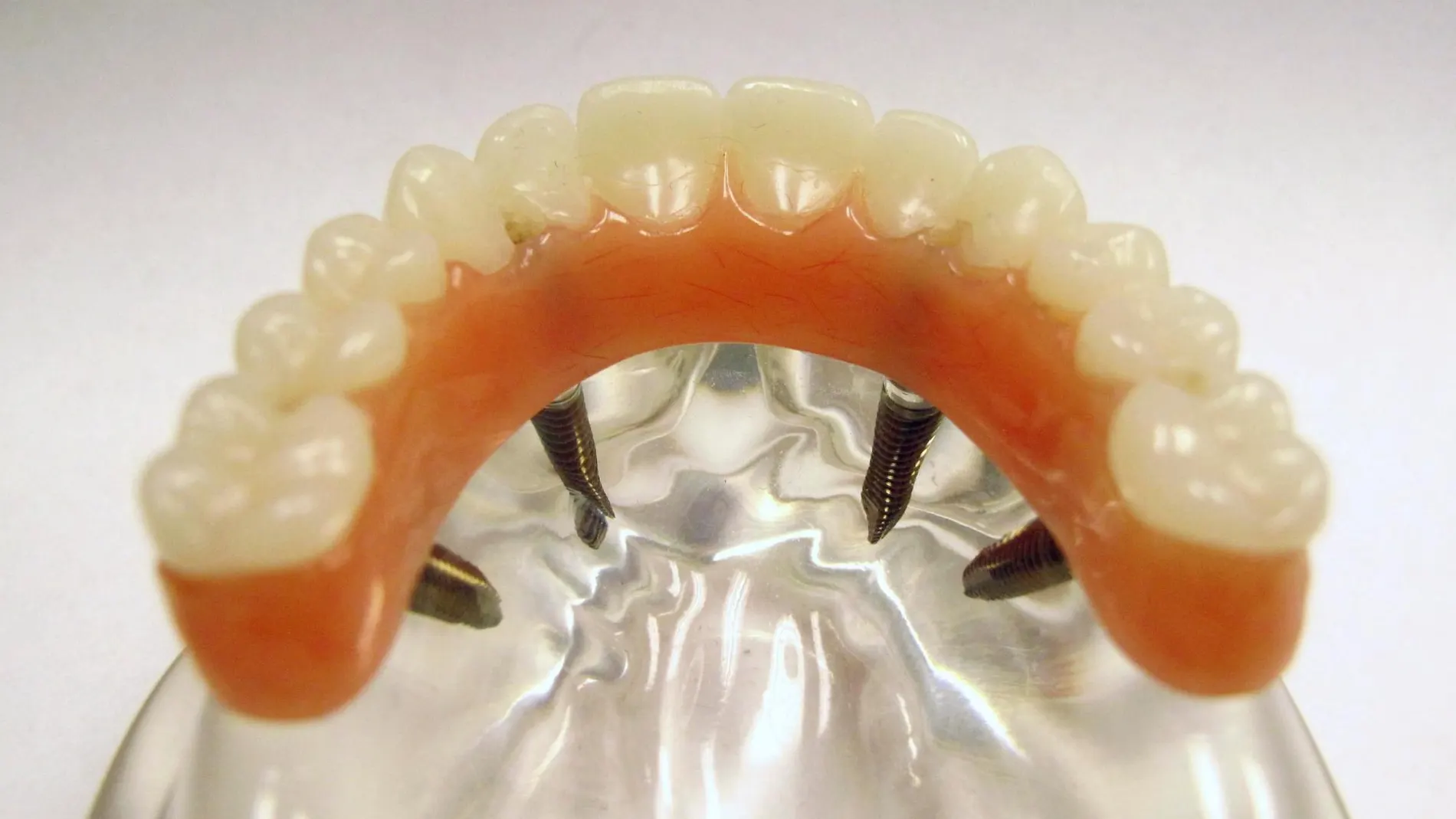 Implantes defectuosos, un grave problema en odontología