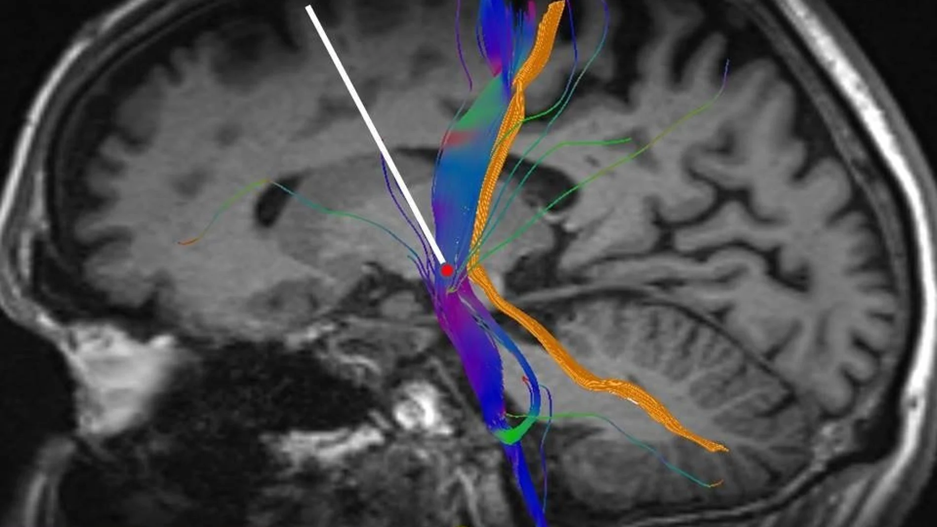 Radiografía cerebral por enfermedad de Parkinson | Ep