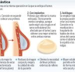 Reconstrucción inmediata de la mama, pieza clave en las unidades de cáncer