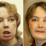 Isabelle Dinoire, tras su primera comparecencia pública después del trasplante, el 6 de febrero de 2006 y, a la derecha, en una foto del 27 de noviembre del 2006, día en el que los cirujanos consideraron que la operación había sido un éxito.