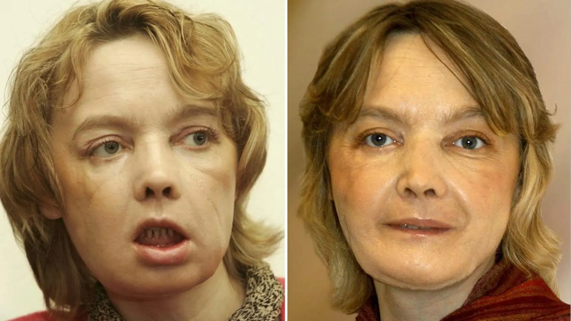 Isabelle Dinoire, tras su primera comparecencia pública después del trasplante, el 6 de febrero de 2006 y, a la derecha, en una foto del 27 de noviembre del 2006, día en el que los cirujanos consideraron que la operación había sido un éxito.