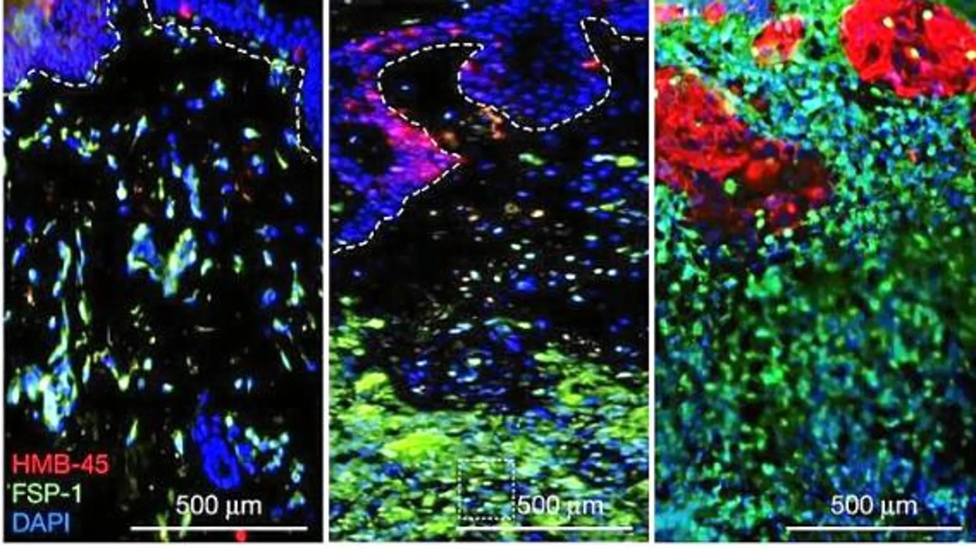 Los científicos han identificado las moléculas capaces de transmitir a la dermis las células cancerígenas