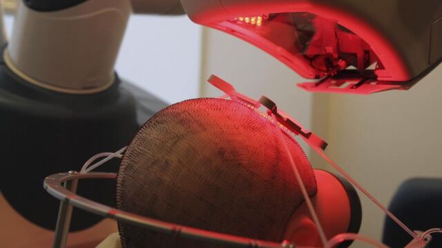 Uno de los sistemas robóticos usados para el transplante de pelo