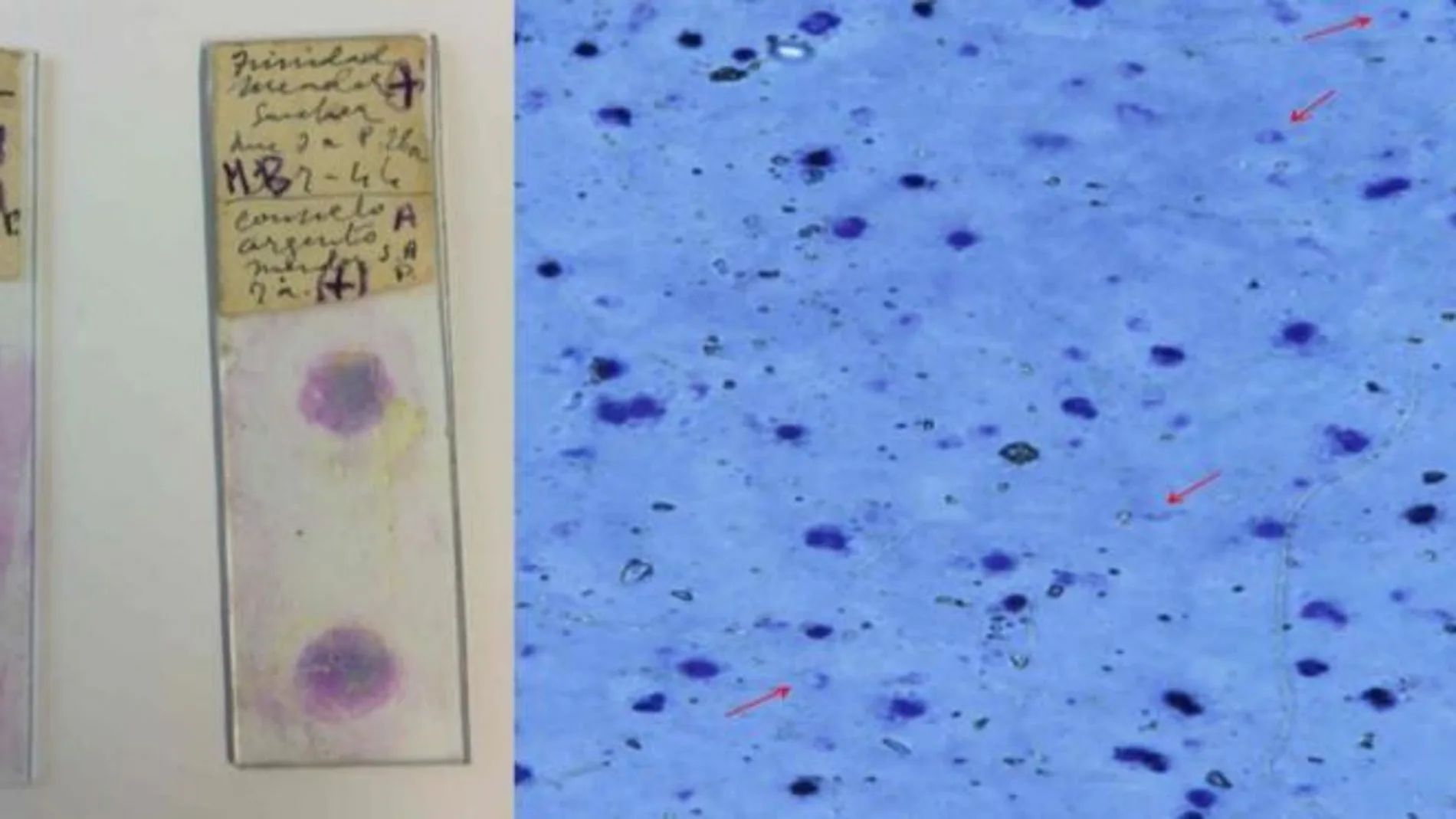Izquierda: dos de las preparaciones antiguas empleadas en el estudio. Derecha: bajo el microscopio, a 400 aumentos, pueden distinguirse algunos parásitos de la malaria